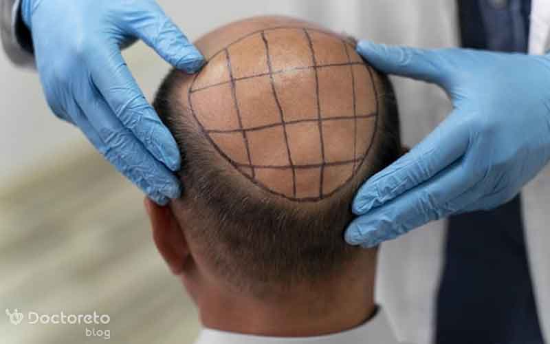 مراحل ریزش مو بعد از کاشت چیست؟