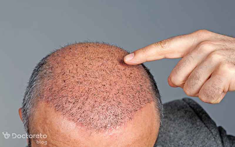 عکس ریزش مو بعد از کاشت چگونه است؟