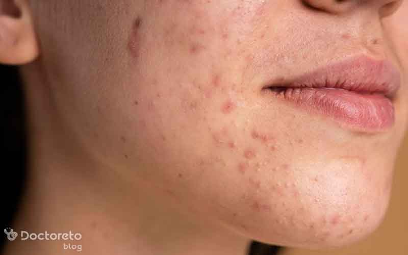 مزوتراپی صورت برای لک برای چه کسانی مناسب نیست؟