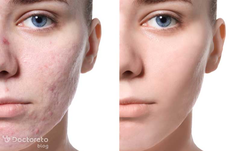 عکس مزوتراپی لک صورت حاکی از تاثیرگذاری آن است.