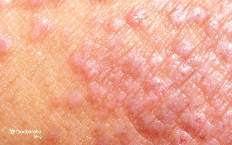 عکس جوش های خطرناک در کبد چرب
