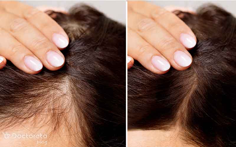 کاشت مو به روش تکثیری چیست؟