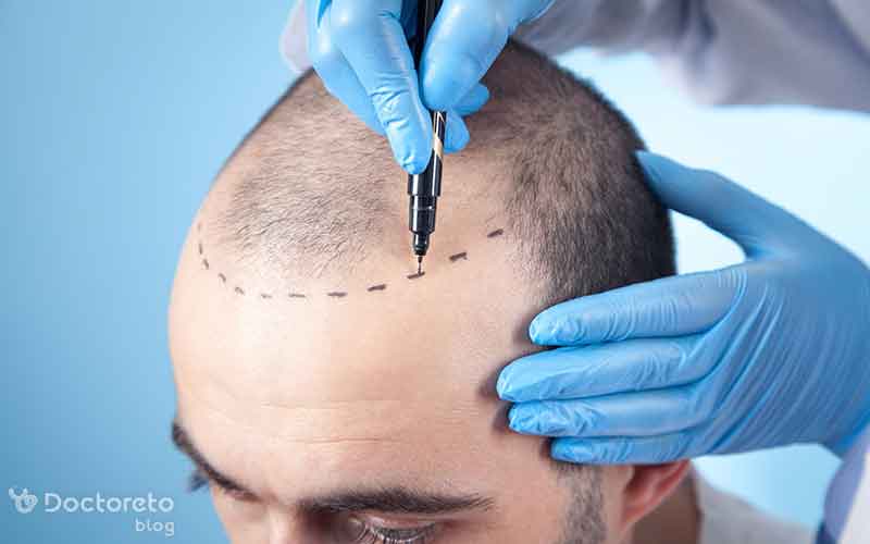 کاشت مو به روش تکثیری چیست؟
