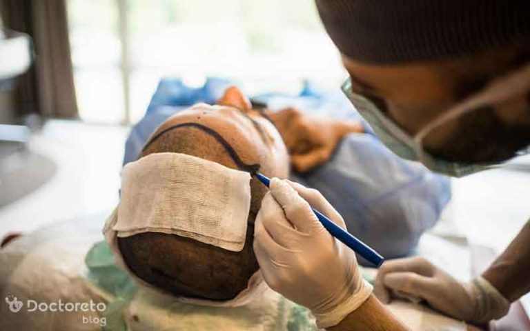 آشنایی با جدیدترین روش کاشت مو