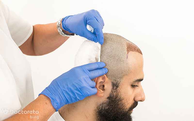 جدیدترین روش کاشت مو با سلولهای بنیادی است.