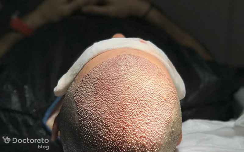 کاشت مو با سلولهای بنیادین چگونه است؟