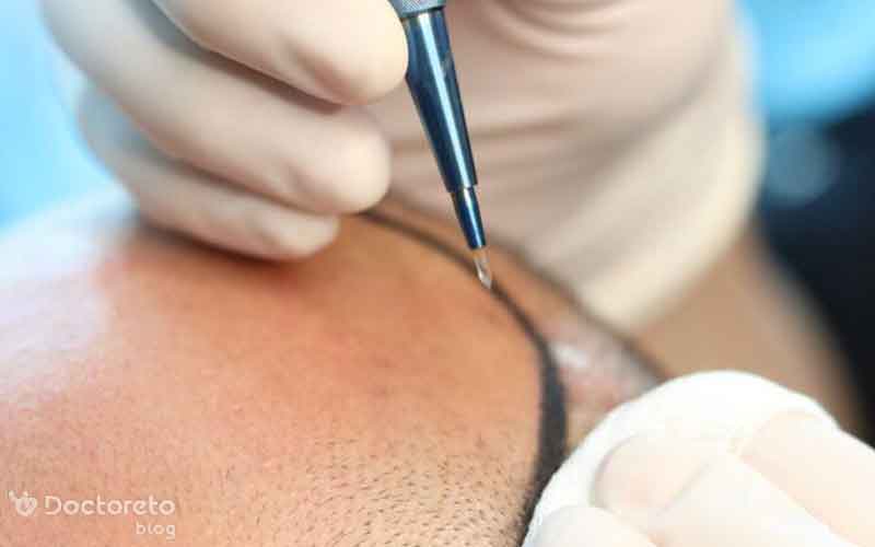 کاشت مو به روش dhi چیست؟