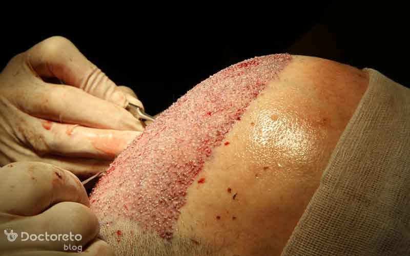 کاشت مو به روش dhi چیست؟