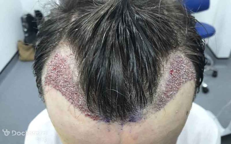 بررسی قدم به قدم مراحل کاشت مو