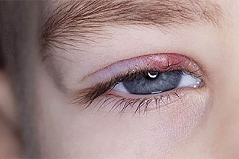 علت گل مژه چیست و چرا به وجود می آید؟