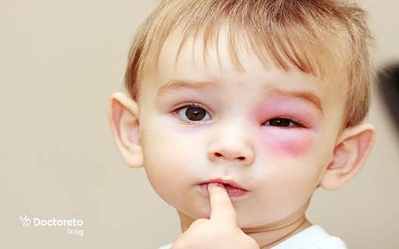 پماد برای گل مژه کودکان چیست؟