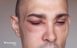 علت ورم صورت بعد از کاشت مو چیست و چگونه مانع بروز آن شویم؟