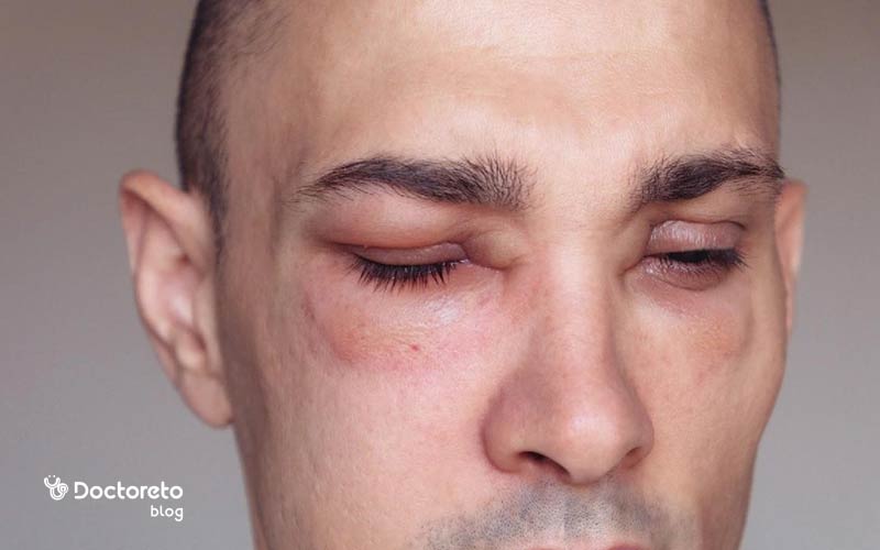 ورم صورت بعد از کاشت مو را چگونه رفع کنیم؟