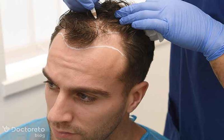 بررسی بهترین روش کاشت مو با تراکم بالا