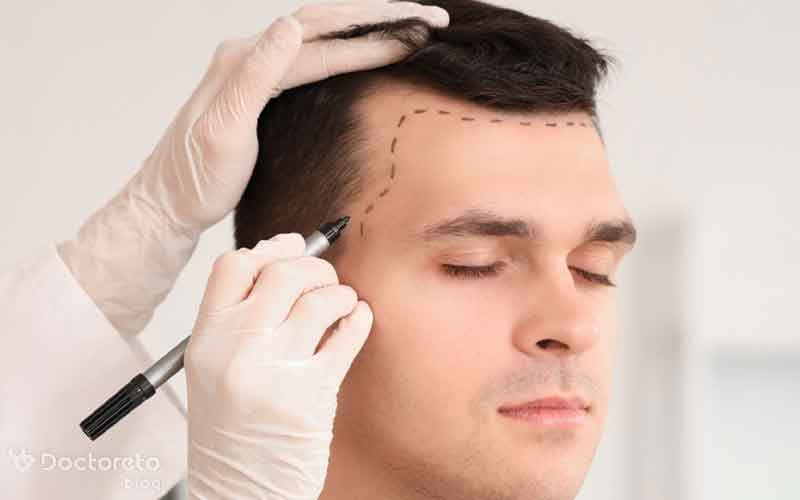کاشت مو با تراکم بالا برای چه افرادی مناسب است؟