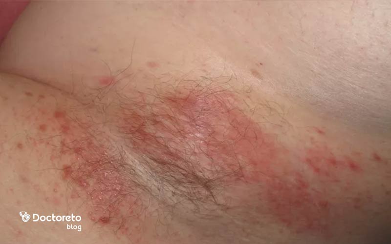 عکس عرق سوز شدن زیر بغل چگونه است؟