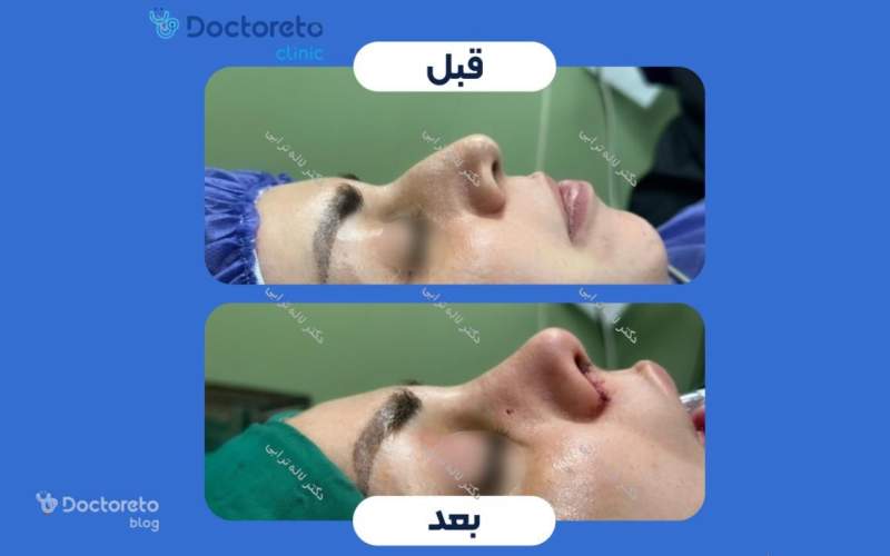 عکس قبل و بعد عمل بینی گوشتی زنان بدین شکل است.