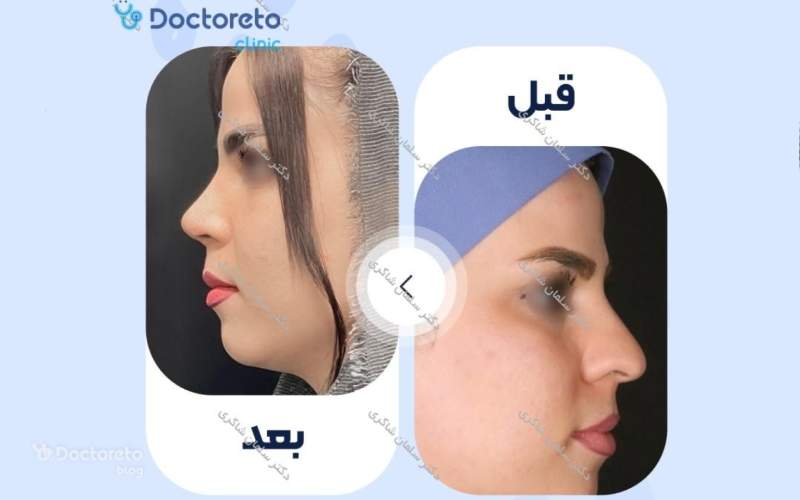 عکس قبل و بعد عمل بینی گوشتی زنانه
