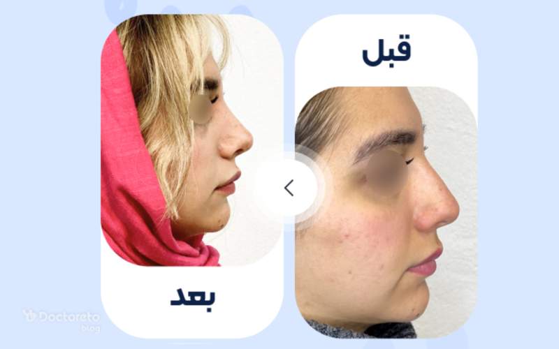 عکس قبل و بعد عمل بینی نیمه گوشتی