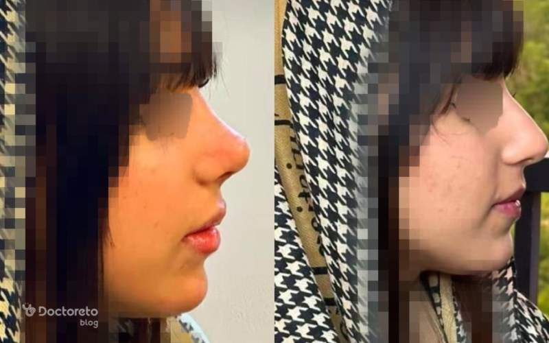 عکس قبل و بعد عمل بینی نیمه گوشتی بدین شکل است. 
