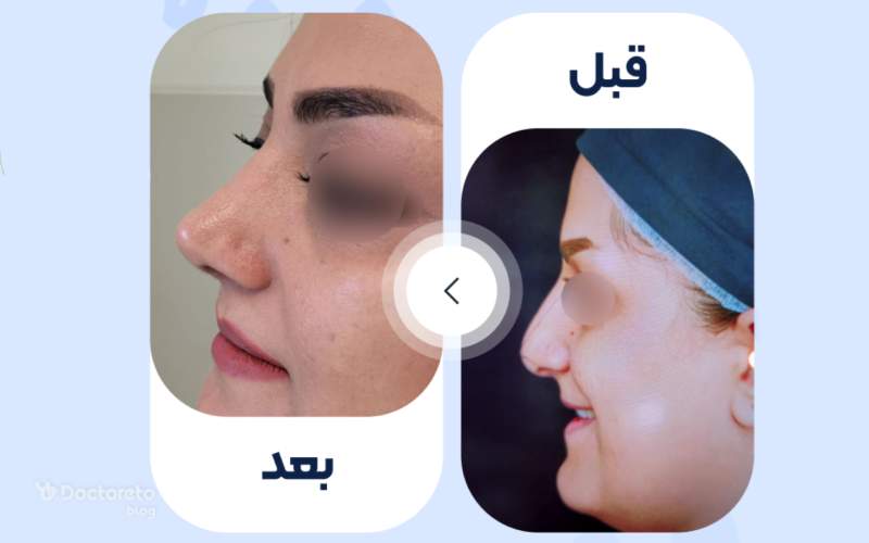 عکس قبل و بعد عمل بینی گوشتی نیمه فانتزی بدین شکل است. 