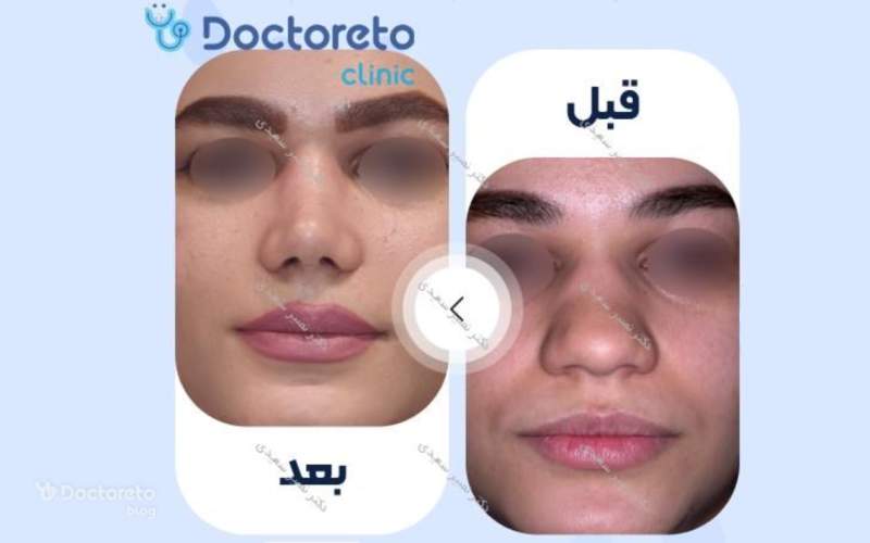 عکس قبل و بعد عمل بینی گوشتی فانتزی بدین شکل است.