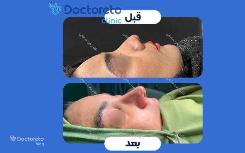 عکس قبل و بعد جراحی بینی گوشتی طبیعی بدین شکل است.