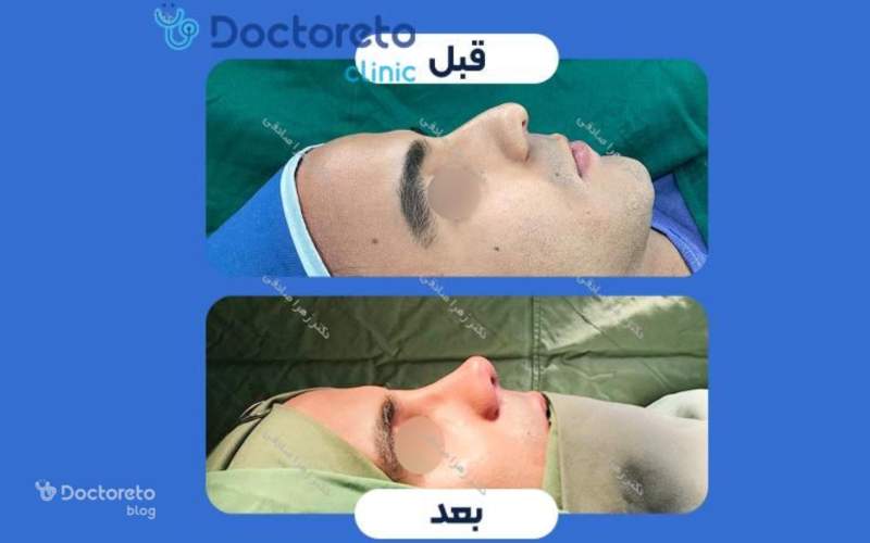 عکس قبل و بعد عمل بینی گوشتی مردانه بدین شکل است.