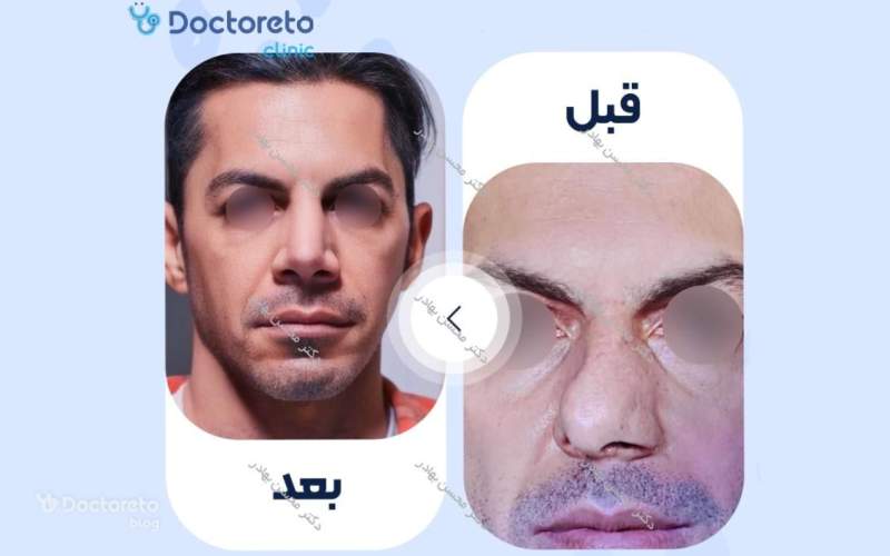 عکس قبل و بعد عمل بینی گوشتی کج بدین شکل است.