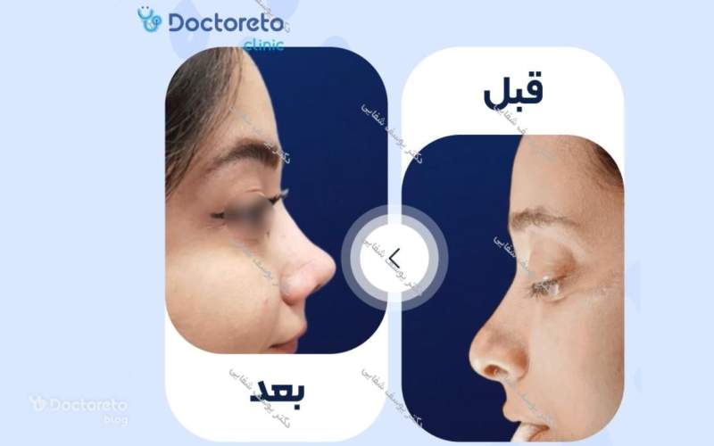 عکس قبل و بعد عمل بینی گوشتی ترمیمی بدین شکل است. 