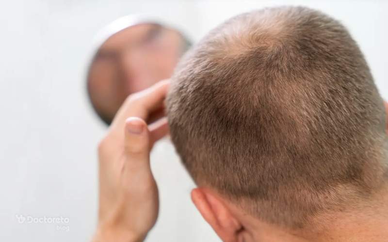 چند جلسه برای تثبیت نتیجه هیر فیلر نیاز است؟