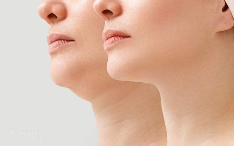 عوارض ساکشن غبغب چیست؟