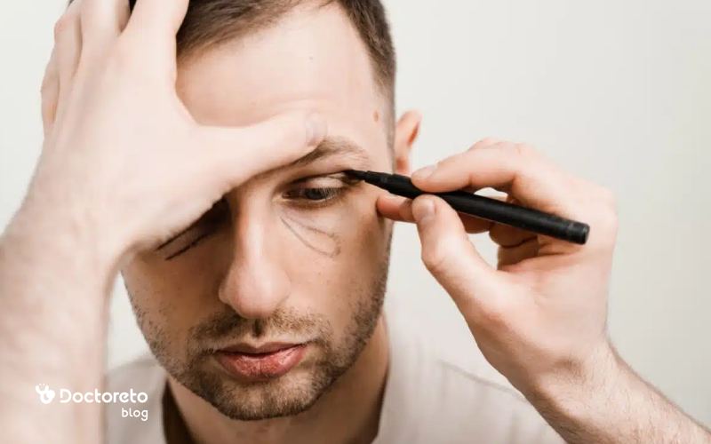 آیا همه بیماران بعد از بلفاروپلاستی به کرم ترمیم کننده نیاز دارند؟