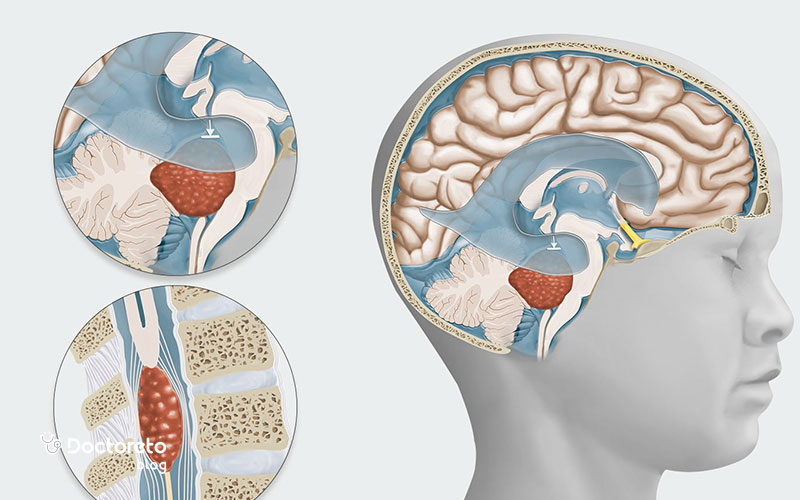 طول عمر بیماران تومور مغزی گرید 4 چقدر است؟