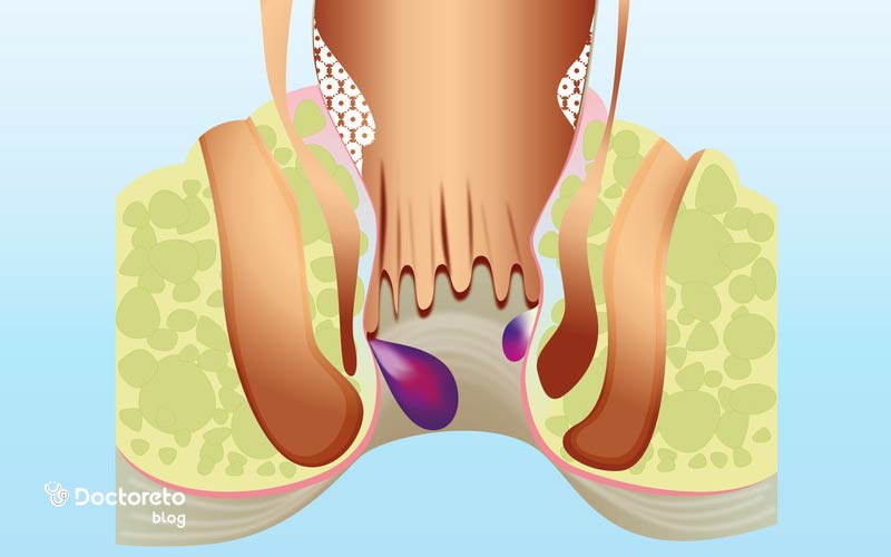 پیشگیری از بواسیر خارجی چگونه امکانپذیر است؟