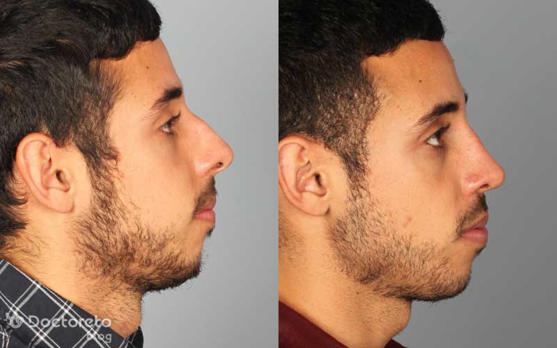 عکس یک نمونه عمل بینی مردانه فانتزی بدین شکل است. 