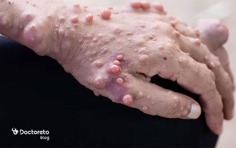 هرآنچه باید درباره بیماری نوروفیبروماتوز بدانید