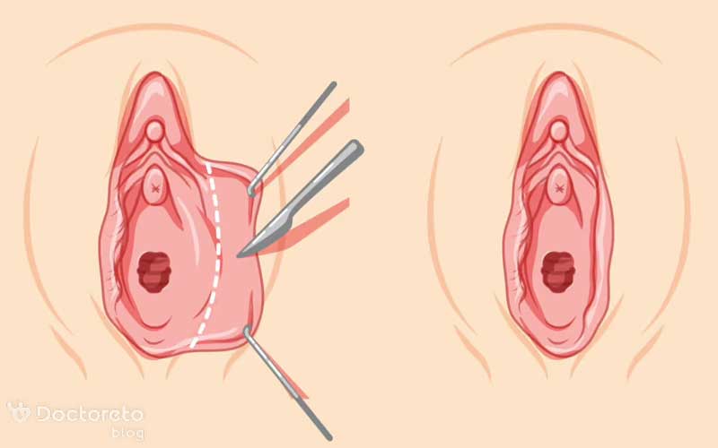 گوشت اضافه بعد از لابیاپلاستی چرا ایجاد می شود؟