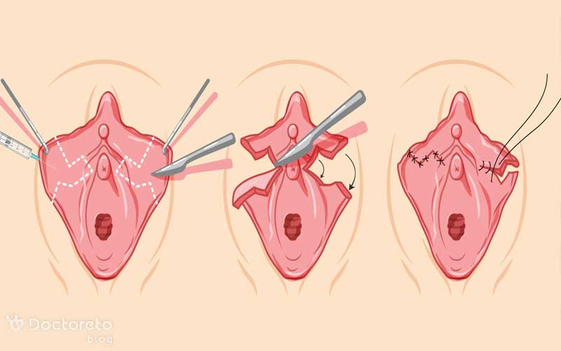 خطای جراحی از دلایل ایجاد گوشت اضافه بعد از لابیاپلاستی است.