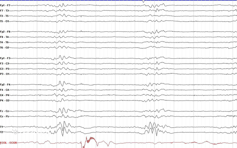 عکس نوار مغز طبیعی بدین شکل است.