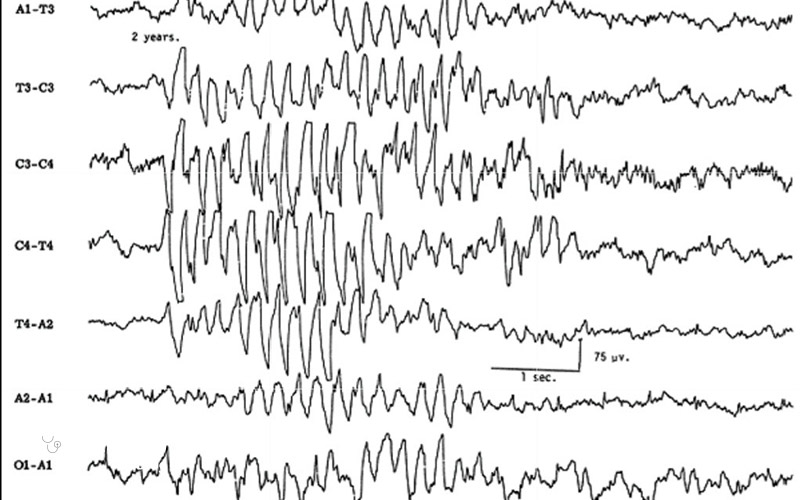 تصویر نوار مغز ناسالم بدین شکل است.