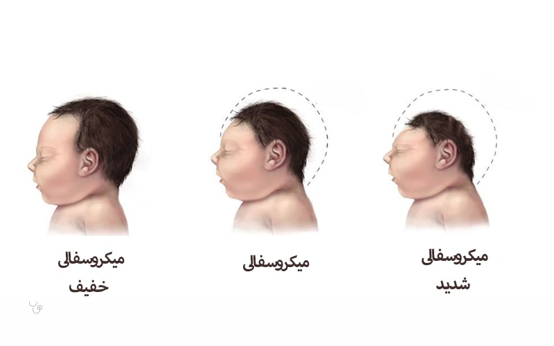انواع میکروسفالی وجود دارد.