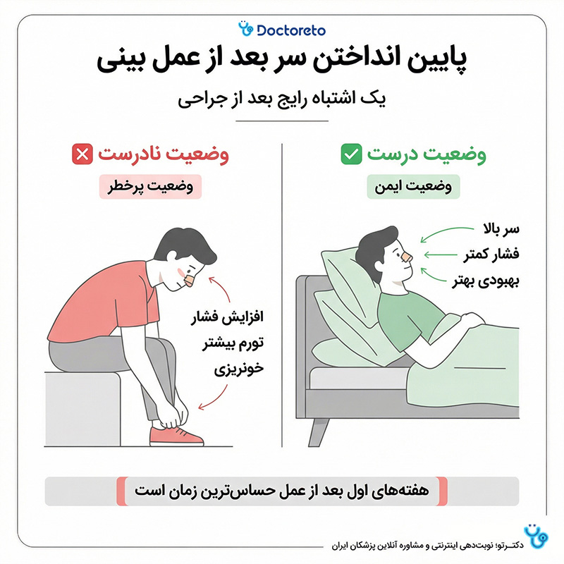 اینفوگرافی پایین انداختن سر بعد عمل بینی