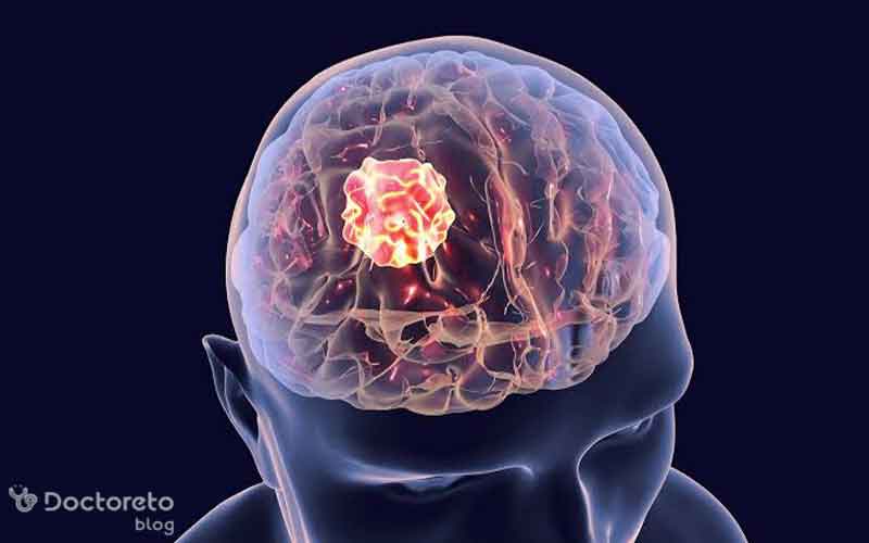 علائم هشدار تومور مغزی در افراد جوان چیست؟