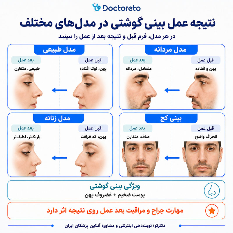 اینفوگرافی عکس قبل و بعد عمل بینی گوشتی