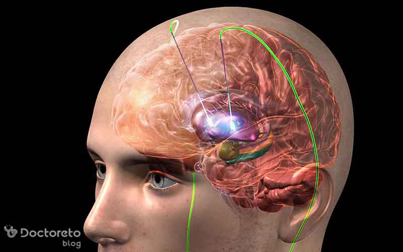 تحریک الکتریکی مغز چیست؟