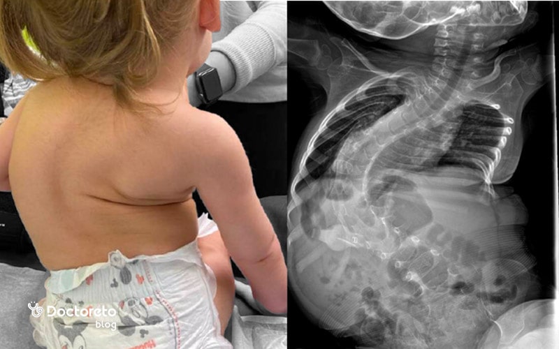 علائم بیماری SMA چیست؟