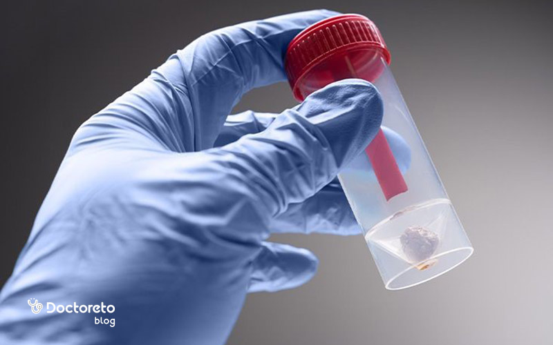 مراحل آزمایش و تجزیه و تحلیل نمونه مدفوع چگونه است؟