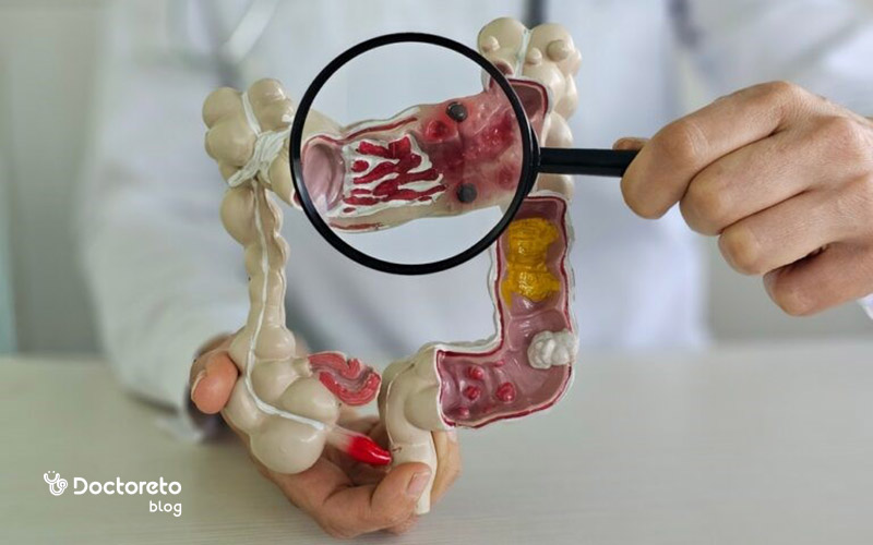 انواع آزمایش مدفوع در تشخیص سرطان روده چیست؟