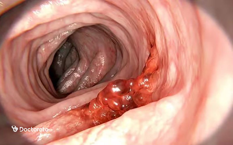 مزایا و محدودیت های آزمایش مدفوع در تشخیص سرطان روده چیست؟